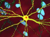 English: single striatal neuron (yellow) transfected with nuclear inclusion (orange) mHtt, other neurons in background (blue), from press release http://www.ninds.nih.gov/news_and_events/press_releases/pressrelease_huntington%27s_inclusion_bodies_101304.h