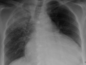 English: Pericardial effusion due to malignancy. Note bulbous heart and primary lung cancer in right upper lobe.