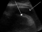 English: A very large hemorrhagic pericardial effusion due to malignancy as seen on ultrasound.