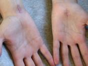 English: Scars from carpal tunnel release surgery. Two different techniques were used. The left scar is 6 weeks old, the right scar is 2 weeks old. A year later the female patient fully recoverd, see Carpal_tunnel_scars_II.JPG