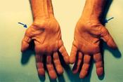 English: Untreated Carpal Tunnel Syndrome