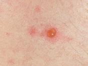 A typical chickenpox blister shortly after appearance. Its fluid contents become cloudy after a day or two.