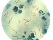 English: Photomicrograph of Streptococcus pyogenes bacteria, 900x Mag. A pus specimen, viewed using Pappenheim's stain. Last century, infections by S. pyogenes claimed many lives especially since the organism was the most important cause of puerperal feve