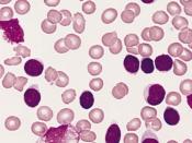 BONE MARROW: B-CELL CHRONIC LYMPHOCYTIC LEUKEMIA Blood smear from an adult male with a marked lymphocytosis. The predominant lymphocytes have very sparse pale cytoplasm, round to slightly oval nuclei, and no evident nucleoli. Three damaged cells are prese