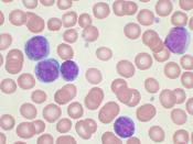 English: High-power magnification (1000 X) of a Wright's stained peripheral blood smear showing chronic lymphocytic leukemia (CLL). The lymphocytes with the darkly staining nuclei and scant cytoplasm are the CLL cells.