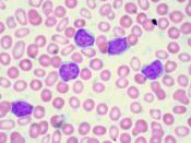 Peripheral blood film from a 70-year-old woman with an absolute lymphocyte count of 41,000/uL. Flow cytometry is pending.