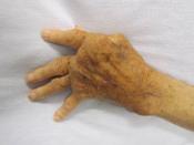 English: A hand affected by rheumatoid arthritis