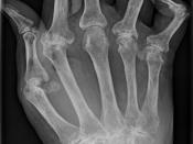 Typisches Röntgenbild einer Rheumatoiden Arthritis.