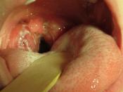 English: A culture positive case of strep throat with typical tonsillar exudate in an 8 year old