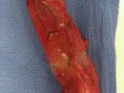 An excised human gall bladder