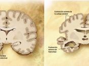English: Combination of two brain diagrams in one for comparison. In the left normal brain, in the right brain of a person with Alzheimer's disease. Diagram of the brain of a person with Alzheimer's Disease. Diagram of a normal brain. Español: Esquema de 
