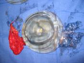 Breast implant: An explanted, ruptured silicone implant; the fibrous capsule, the shell, and the extruded filler gel.