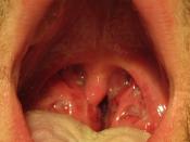English: A throat infected with group A streptococcus.