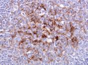 tonsil biopsy in variant CJD. Prion Protein immunostaining