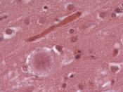 Variant Creutzfeldt-Jakob Disease. Cortex with florid plaques. Hematoxylin-eosin Staining