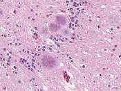 Variant Creutzfeldt-Jakob disease (vCJD), typical amyloid plaques, H&E