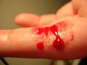 Bleeding wound on finger