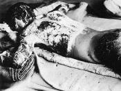 Victim of Atomic Bomb of Hiroshima. 日本語: 似島検疫所にて。全身に大やけどをおった犠牲者。