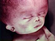 English: Photo of baby with hydrocephalus (spina bifida)