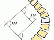 Cobb angle measurement of a scoliosis; concave side on the left; convex side on the right