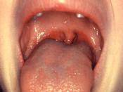 English: Tonsillitis Français : Angine - CDC (Centers for Disease Control and Prevention)- Public Health Image Library (PHIL) - ID#:6375 (cropped version)
