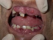 English: Diffusely swollen gums due to acute myelomonocytic leukemia