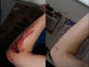 English: A comparative picture of untreated 7-days-healed road rash in the form of a scar one year later. Fresh wound is on the right, and scar is on the left.