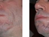 English: A pair of images showing subject with acne scars on left, and one day after scar revision surgery (on the right). Location of sutures and nature of surgery reveals how scar revision works.