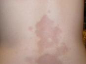 Morphea located on the back of a 16 year old caucasian woman