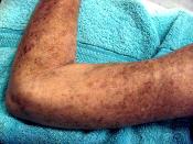 Picture of a female patient's left arm, showing skin lesions caused by Scleroderma.