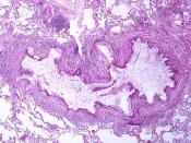 Asthma Obstruction of the lumen of the bronchiole by mucoid exudate, goblet cell metaplasia, epithelial basement membrane thickening and severe inflammation of bronchiole.