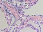 Microcystic adenoma of pancreas