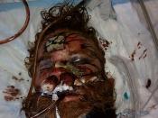 Kelly Thomas, after a fatal beating by officers of the Fullerton, California Police Department