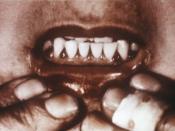 Scorbutic gums, a symptom of scurvy. Note gingival redness in the triangle shaped interdental papillae