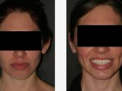 English: Plastic surgery; Otoplasty; 2-plate photograph; otopexy correction; Woman.