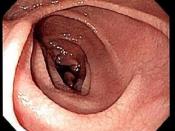 English: Endoscopic image of duodenum in individual with celiac disease, showing scalloping of the folds and cracked-mud appearance of the mucosa.