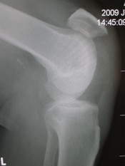English: Patellar tendon rupture showing a marked distance between the tibial tuberosity and the bottom of the patella.