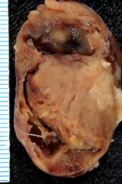 English: The cut surface of a very large (4-centimeter) parathyroid adenoma removed from a woman who had hyperparathyroidism and hypercalcemia. Following surgery, her serum calcium level returned to normal.