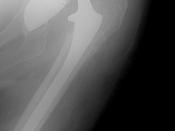 English: A dislocated hip prosthesis.