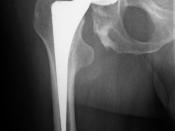 Hip-Joint, total Replacement, insertion without bone-cement