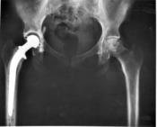 The patient’s right hip joint replaced by a metal head and a plastic cup.