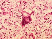 English: Histopathology of measles pneumonia. Giant cell Deutsch: Riesenzelle bei einer Masern-Pneumonie (Lungenentzündung). Feingeweblicher Schnitt. Español: Células infectadas por el virus del sarampión