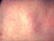 English: This is the skin of a patient after 3 days of measles infection; treated at the New York - Presbyterian Hospital. Prior to widespread immunization, measles was common in childhood, with more than 90% of infants and children infected by age 12. Re