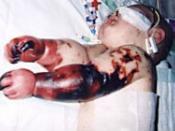 Charlotte Cleverley-Bisman with meningococcal disease