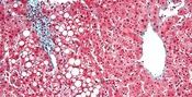 Micrograph of periportal hepatic steatosis, as may be seen due to steroid use. Trichrome stain.