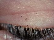 English: Pubic lice on eyelashes, close-up