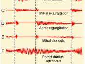 English: Phonocardiograms from normal and abnormal heart sounds