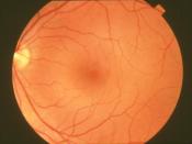 Fundus, photograph-normal retina Description: Fundus photograph-normal retina Credit: National Eye Institute, National Institutes of Health Ref#: EDA06
