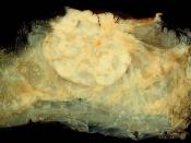This mastectomy specimen contains an infiltrating ductal carcinoma of the breast. A pathologist will use immunohistochemistry and fluorescent in-situ hybridization to detect markers which determine the optimal chemotherapy regimen for this patient.
