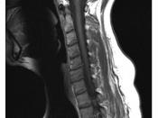 English: T1 weighted sagittal cervical spine MRI showing degenerative disc disease, osteophytes, and osteoarthritis of C5-C6